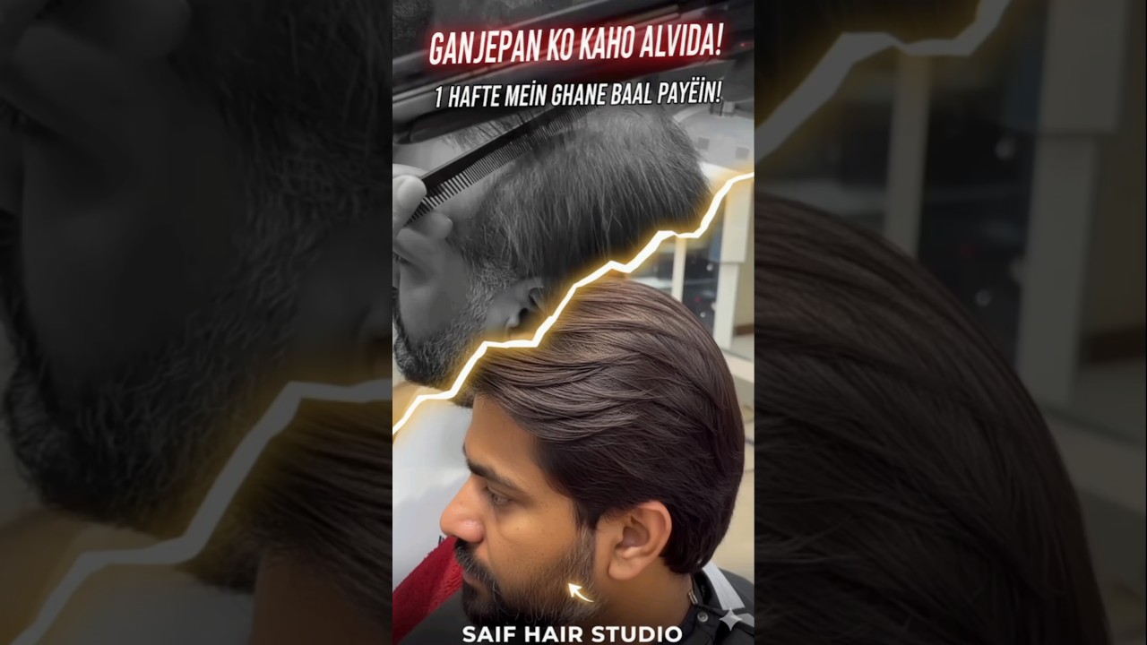 Ganjepan Ka The End 💇‍♂️ | Real Hair Transformation | Saif Hair Studio" 