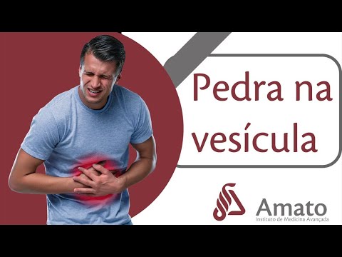 Colelitíase: presença de