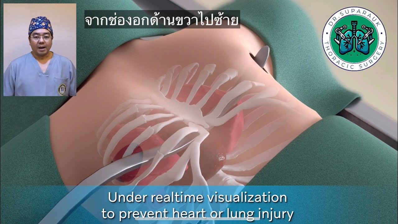 อกบุ๋ม รักษาได้ แผลเล็ก ฟื้นตัวไว  Funnel chest restored with minimally invasive surgery