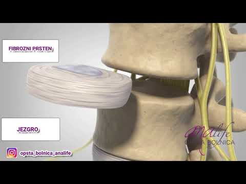 Video: Kako liječiti osteopeniju: 9 koraka (sa slikama)