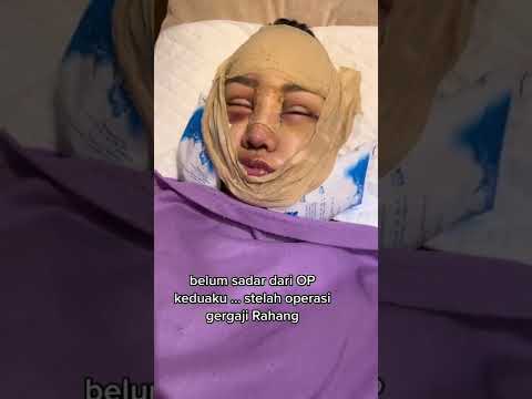 Lucinta Luna belum sadarkan diri setelah operasi gergaji rahang #lucintaluna