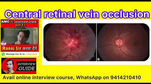 Central retinal vein occlusion | CRVO | Army Doctor Interview questions | AMC | Interview Guide