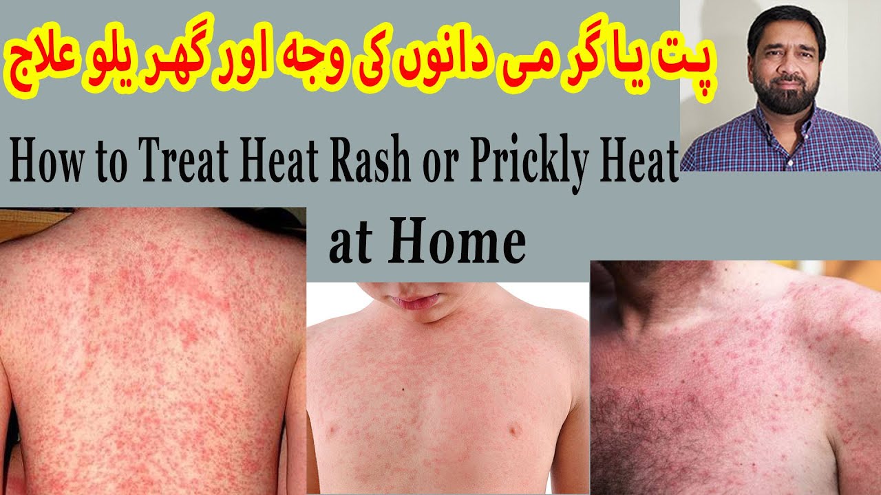 Prickly Heat Treatment Skin Rash Red Skin Rash Miliaria Rubra 