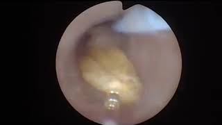 Ureteral Stone Dusting  performed by Michael E  Lipkin MD