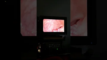Quanto tempo demora uma biópsia do intestino?