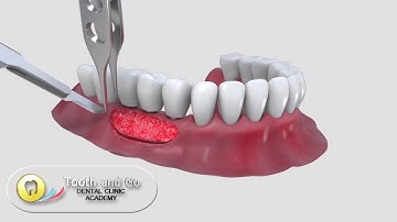 Free Gingival Graft