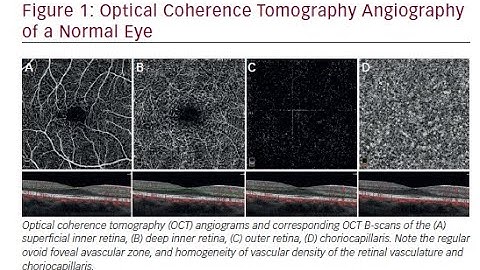 OCT Angiography Or Optical Coherence Tomography Angiography ; How it works, Applications