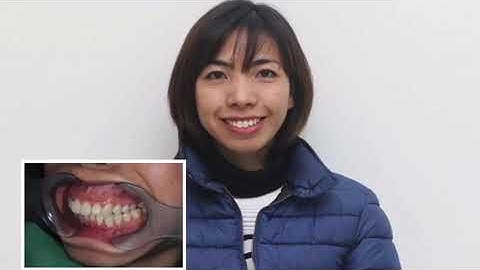 NIỀNG MẶT LƯỠI - KH HOÀNG THỊ HUỆ - NHA KHOA QUỐC TẾ DRDEE