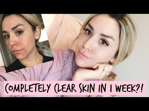 CLEAR EVEN SKIN IN  WEEK! CHEMICAL PEEL RESULTS + ACNE STORY