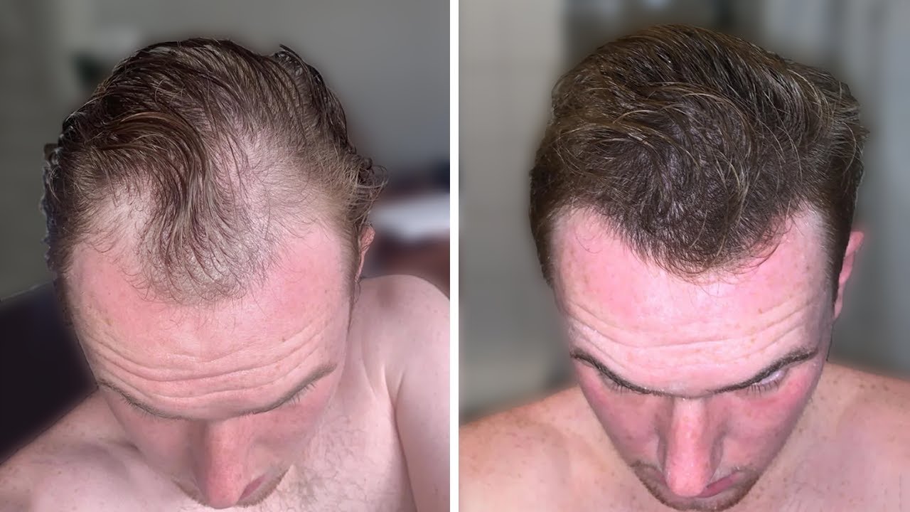 ¿El Secreto Para Recuperar El Pelo Sin Pastillas?