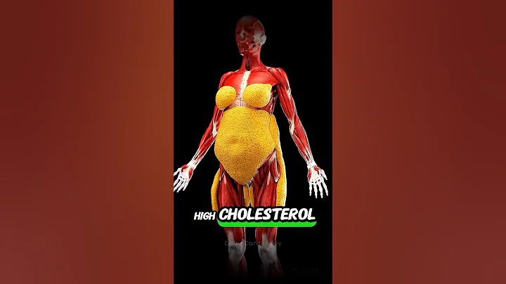 High Cholesterol = Heart Attack?     #cholesterol #heartattack #hearthealth #shorts