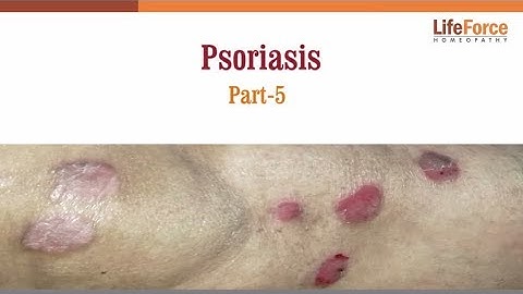 What should you know about Psoriasis treatment - Part 5
