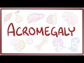 Acromegaly