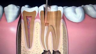 Endodoncia, Poste y Corona, Clínica DentAll en Guadalajara y Zona metropolitana