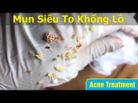 Điều trị mụn u nang ( ở Tai ) hiệu quả. Tại Hiền Vân Spa