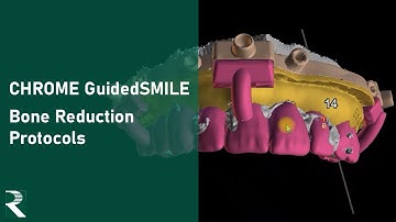 Bone Reduction Protocols for a CHROME GuidedSMILE Natural Case