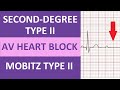 Understanding Second Degree Type 2 Heart Blocks