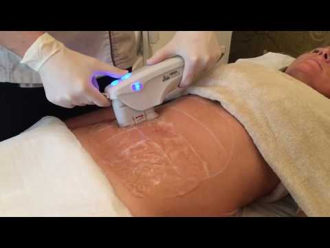 Video: 5 Vrsta Laserskih Tretmana Kože I Njihove Prednosti