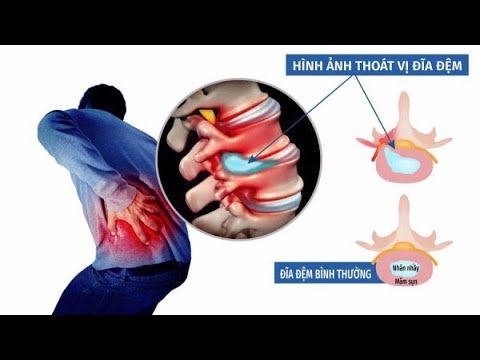 แนวทางการเล่น blacksmith ro m Update New Thoái hóa thoát vị - Vtv2 và Bs.Khánh Vân chia sẻ về phương pháp hiệu quả nhất hiện nay
