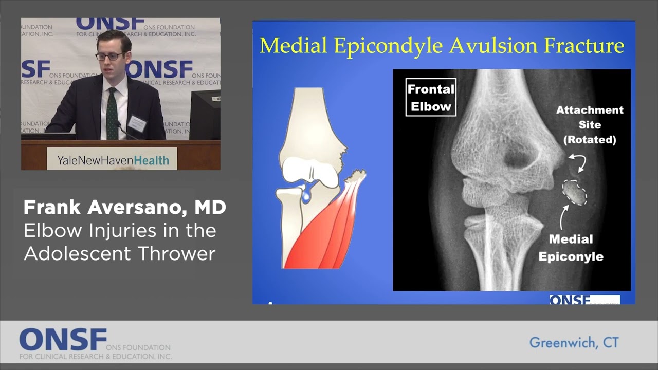 Frank Aversano, MD -  Elbow Injuries in the Adolescent Thrower