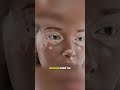 Title:Vitiligo Skin Condition Explained (3D Animation)#vitiligo #dermatology#medical3d #3danimation
