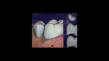 3-Unit Bridge Design (Inlay, Pontic & Anatomic Crown)