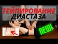 Тейпирование при диастазе. Лечебное кинезиотейпирование живота