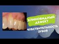 Клиновидный дефект. Чувствительность зубов.