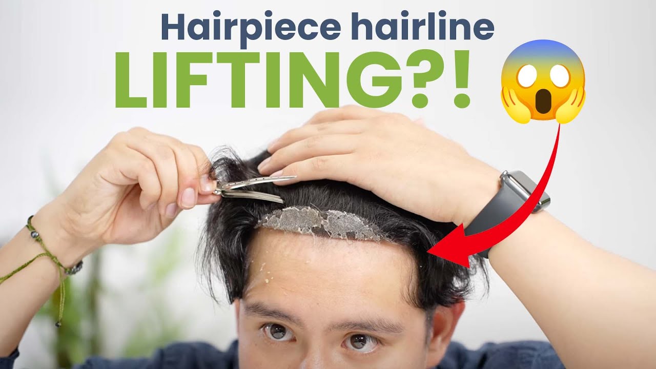 Can You FIX a Lifting Front Hairline Emergency?!