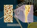 Osteoporosis-3D Medical Animation