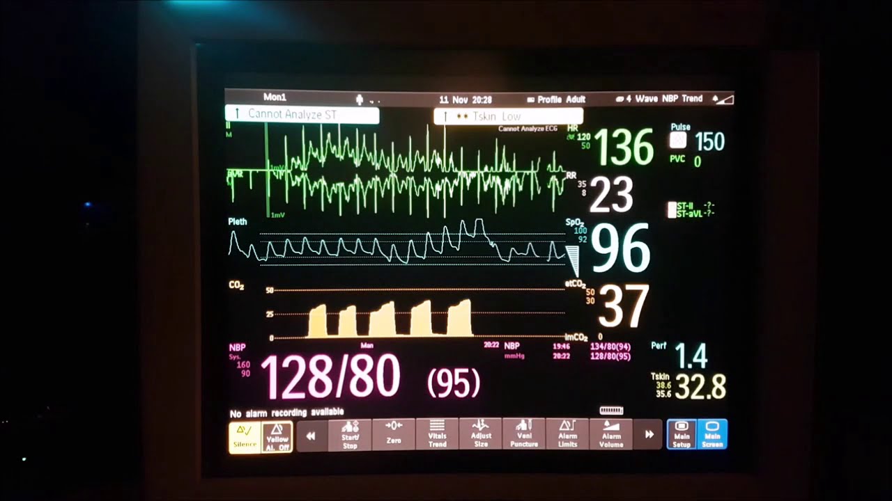 心電図モニター 実際の測定 Tachycardia 頻脈 Philips Intellivue Mp70 Youtube