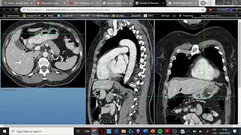 ¿Qué órganos se ven en un TAC de abdomen?