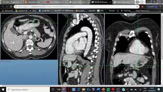 TAC de abdomen! Reconociendo estructuras (1)