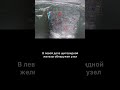 #узи #аденомащитовиднойжелезы
