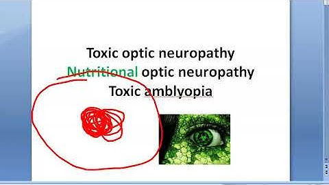 Ophthalmology Toxic Amblyopia Optic Neuropathy Tobacco Ethyl alcohol methyl methanol blindness eye