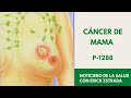 P 1288 Cáncer de mama