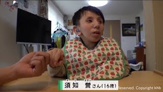 A boy with Cockayne syndrome, a rare disease that causes rapid aging at a young age; parents give...