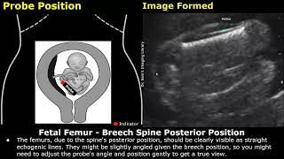 Fetal Femur Ultrasound Probe Positioning & Image Formation | FL USG Scanning Technique & Orientation screenshot 4