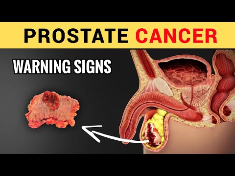 13 Early Silent Signs of Prostate Cancer (Don't Ignore) | Symptoms of Prostate Cancer
