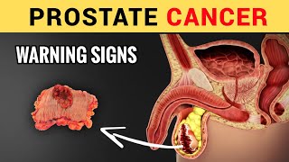 Celebrity 13 Early Silent Signs of Prostate Cancer (Don't Ignore) | Symptoms of Prostate Cancer Wealth