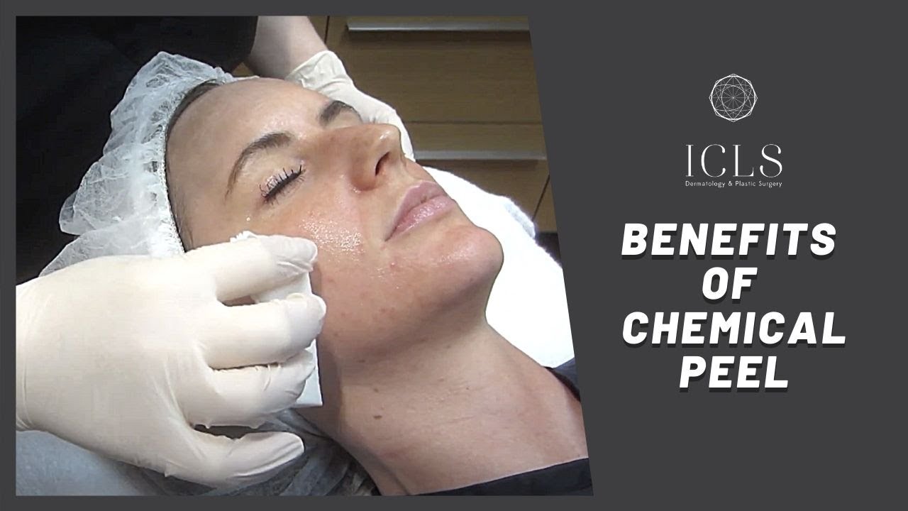 Chemical peels from a dermatologist