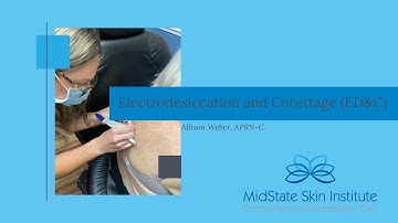 Electrodesiccation and Curettage (ED&C)- performed by Allison Weber, APRN-C