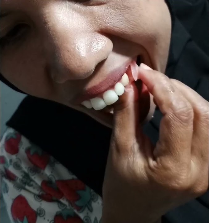 cara pasang gigi palsu flexible #gigi #gigitiruan #flexibledenture #sorts
