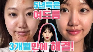 [3Mins Bora] How to get rid of cystic&inflammatory acne, how I manage acne-prone skin