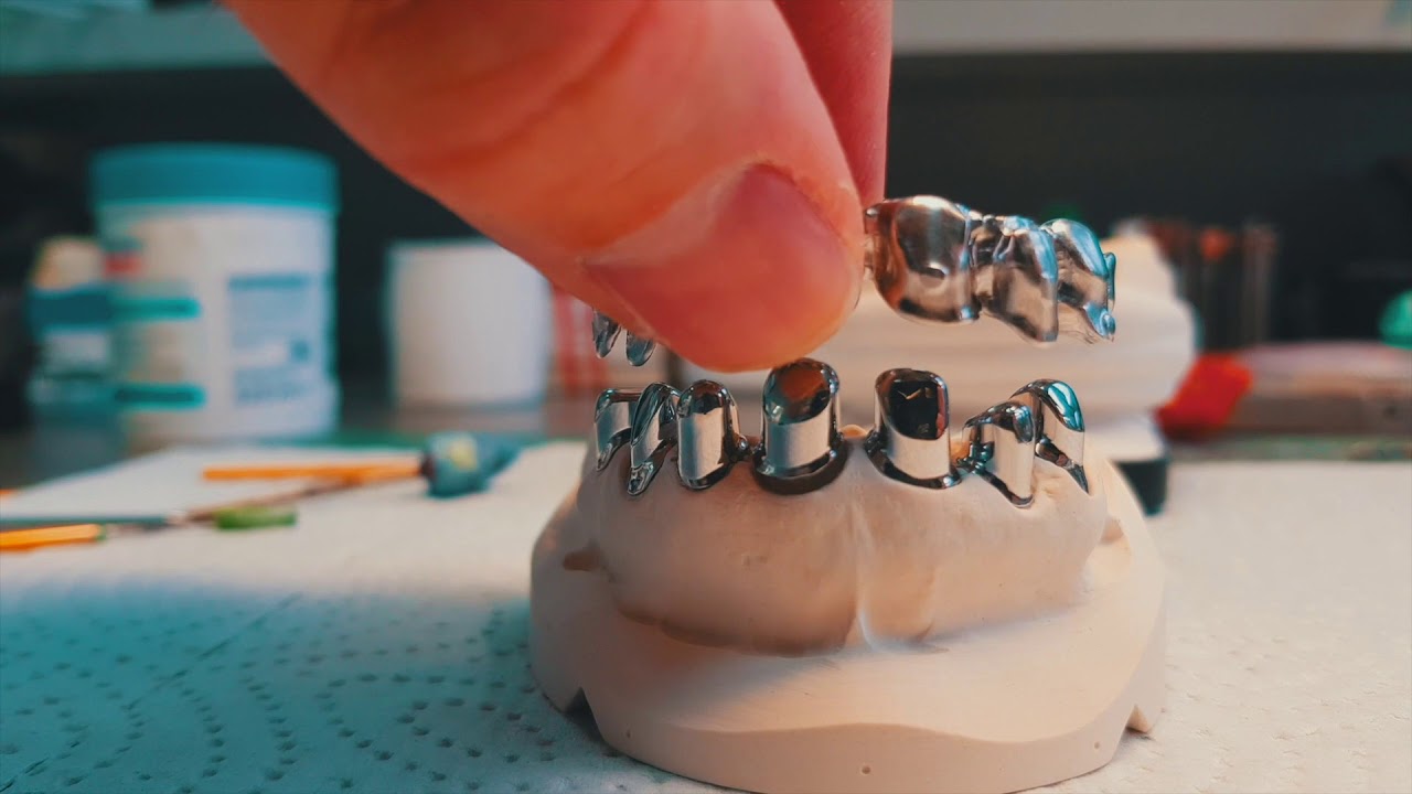 Teleskopierende Kronen mit 1Grad