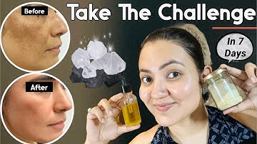 मुश्किल से मुश्किल झाइयाँ Hyperpigmentation Melasma काले धब्बे Spots का इस Remedy से होगा 100% इलाज