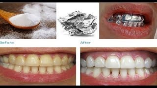 تبيض الأسنان في 5 دقائق وبمكونين فقط  /  whiten teeth at home in 5 minutes