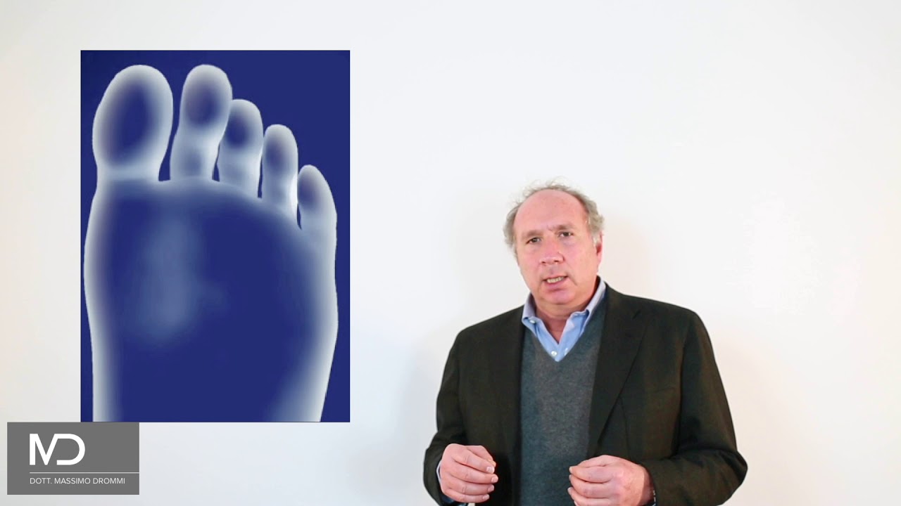 Metatarsalgia a cura del Dr Massimo Drommi