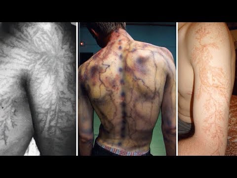 Video: 19 People Who Survived After Being Struck By Lightning, Which Left Indelible Patterns On Their Bodies - Alternative View