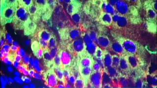 Nanoparticles for Cancer Treatment Video - Brigham and Women's Hospital
